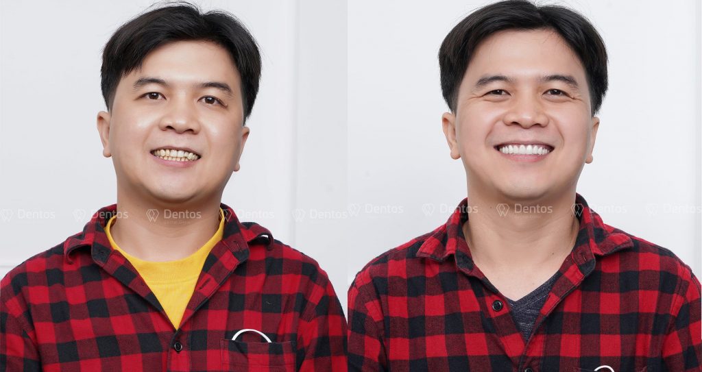 Răng sứ thẩm mỹ giá rẻ có nguy cơ bị vỡ